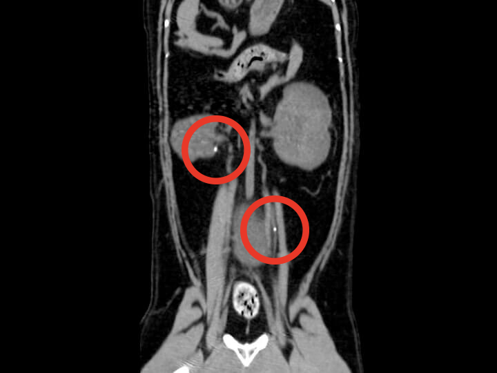 CT検査だからわかること