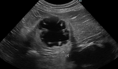 両側の尿管結石と診断された猫